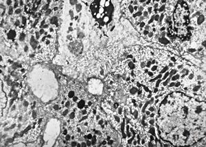 M,18y. | dilated primary bile ducts - blocked bile transport